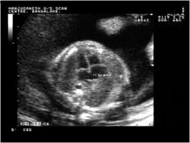 Ultrasound Wave Reflection: Examples: A-mode: 1D imaging, Eye s Layers.