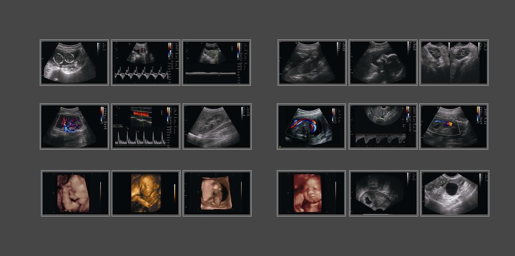 IMAGING SYSTEMS Clinic Value & Twins, B Mode Fetal Heart, PW Mode Uterus, PW Mode Kidney, CFM