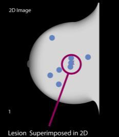 2D Breast Imaging Single projection results in tissue superimposition that is created by the overlap of normal breast structures 3D Principle of Operation