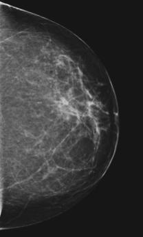 2D Mammogram Tomosynthesis 2D Mammogram Tomosynthesis Better Sensitivity
