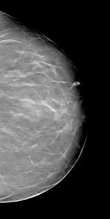 Advantages Imaging dense breast tissue May decrease recall rate Addresses