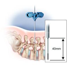 Guidewire Placement Vertical Marker Select the threaded Guidewire with a blunt or sharp tip, based on surgeon preference. Insert the Guidewire into the Jamshidi Needle.