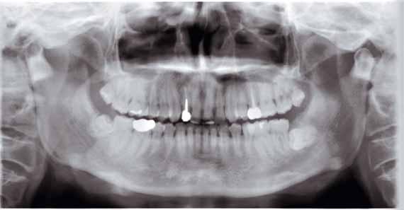In this way the overlapping of neighboring teeth or the shadow on the mandibular ramus is reduced.