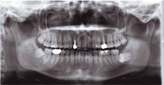 X-ray projection angle Images with less overlapping of teeth Orthoradial Panoramic, Mag.:1.3 x constant (Mag.: 1.