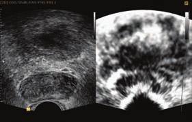 HDVI TM HD Volume Imaging (HDVI ) gives outstanding image quality and naturally clearer contrast, with excellent tissue differentiation, edge depiction and speckle reduction, allowing