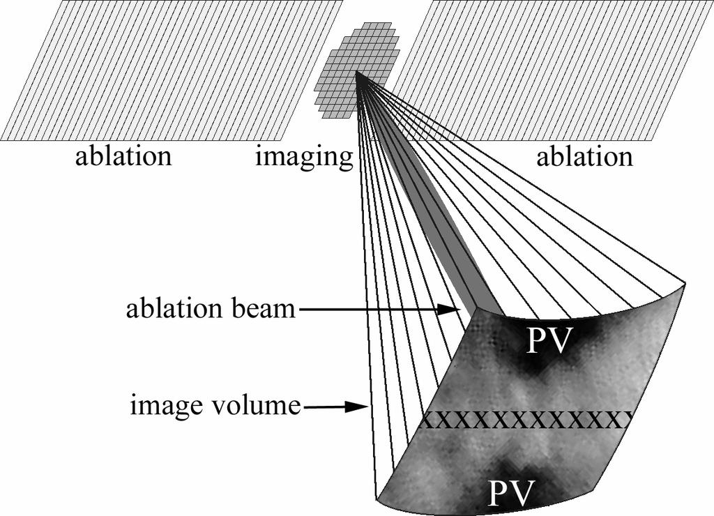 PZT-4 ablation annulus (outside diameter of 4.5 mm and inside diameter of 3.1 mm) placed 7, 8 around the imaging array (Fig. 1b).