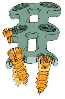 Cervical Vertebrae Plate System consists of plates with and Locking Screws.