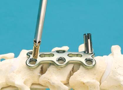 Self-Tapping Screws With Variable Medial Angulation (continued) 5 Insert self-tapping expansionhead