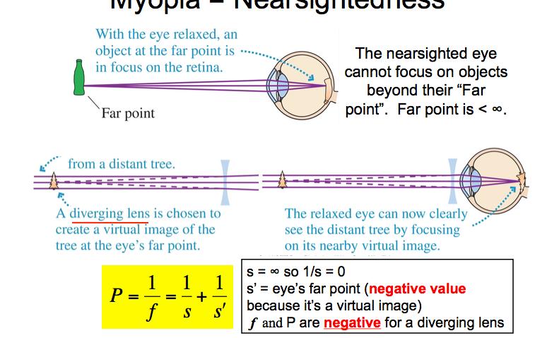 Nearsightedness-myopia object distance p=infinity; q=eye s far point (negative since it s a