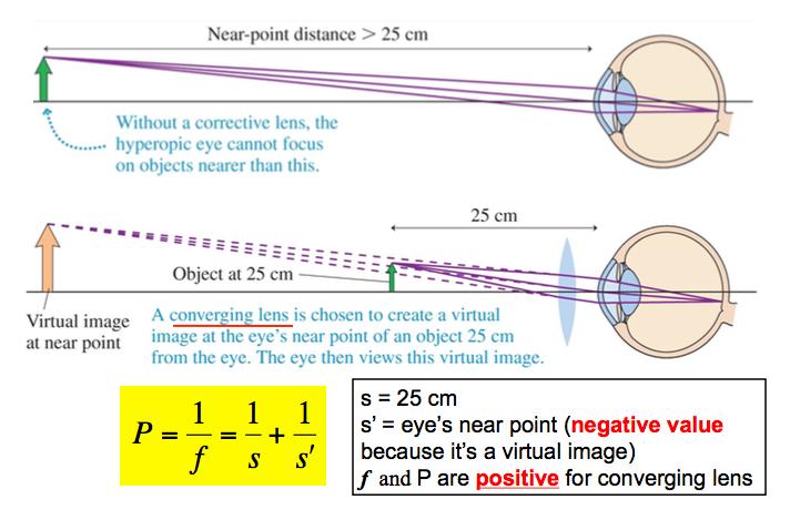 Farsightedness-hyperopia object distance p=25 cm; image distance q = eye s near point
