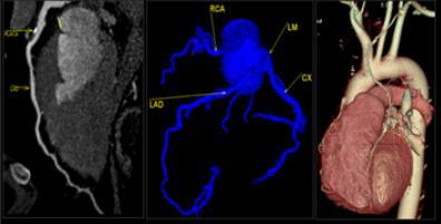 Model based, noninvasive diagnosis of coronary artery