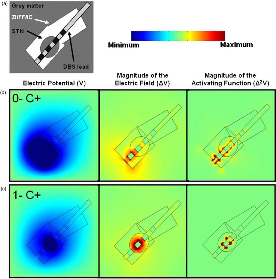 Electrical targeting: Effect of contact location on distribution of the electric field (a) Model of the DBS lead with four contacts centered in the STN, surrounded by white fiber tracts and grey