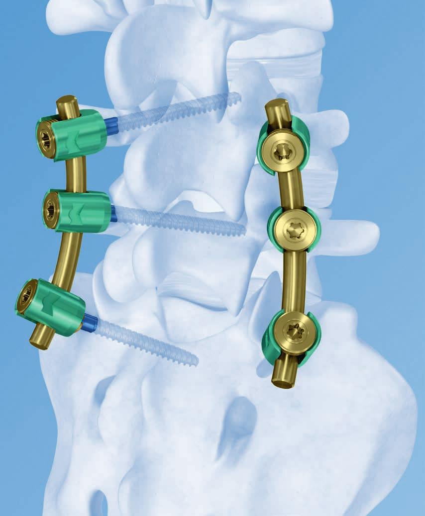 URS Degen. Top loading pedicle screw system for posterior stabilization.
