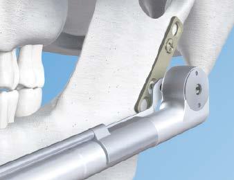Low-profile head Minimal overall height Optimized drive design Easy to clean Facilitates intraoral treatment of subcondylar fractures.
