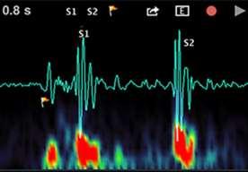 Fig -5: Two primary heart sounds: S1 and S2. 4.2 Features Low level heart and lung sounds are amplified with clear audibility so that in noisy area also proper auscultation is possible.