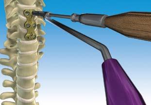 Secure the screw to the driver and insert a bone screw into the Drill Guide cannula.