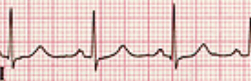 Exercise 2 The following two figures were produced from an EKG (electrocardiogram) from the same patient.