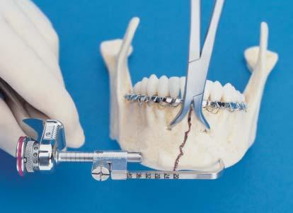 Caution: Position the device so that the predetermined drill path avoids tooth roots.