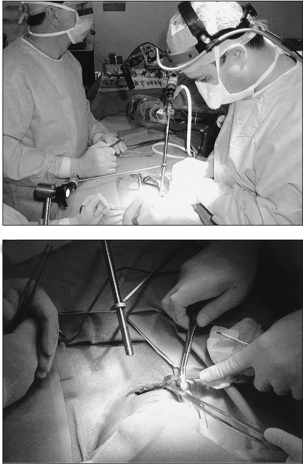 A 45-degree laparoscope was positioned in a lowprofile angle facing the operative field.