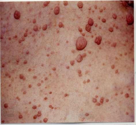 Signs of NF1 If you have NF1 you will get lumps and bumps.