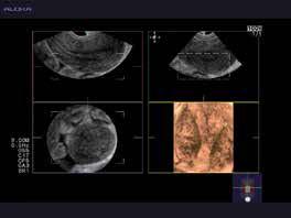 Global understanding of the fetal heart using STIC Dynamic Slow-motion Display (DSD) Observe the fast
