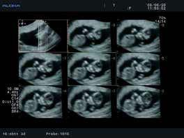 The fetal heart, valve leaflets, and regurgitation flows and other fast moving objects can be observed