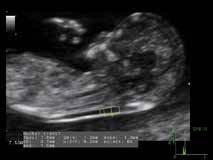 Automated Nuchal Translucency (NT) Measurement M-mode imaging from any angle of the fetal heart, using