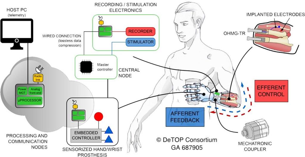 feedback Recovery of hand function after amputation beyond the myoelectric prostheses
