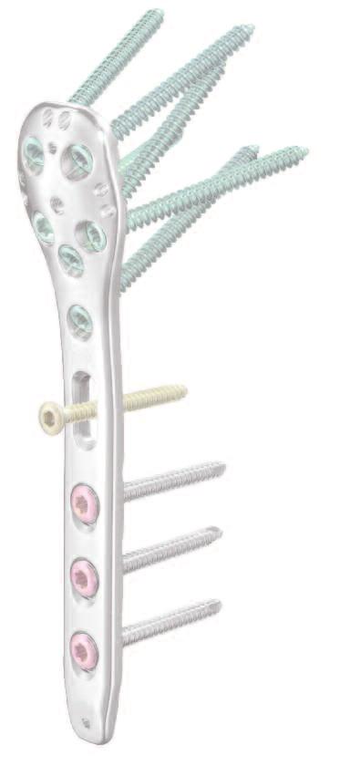 of the plate to the bone Locking screws are positioned in a diverging manner in order to ensure a high degree of stability in normal and